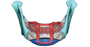 virtual-surgical-models-3d-systems-healthcare-3.jpg